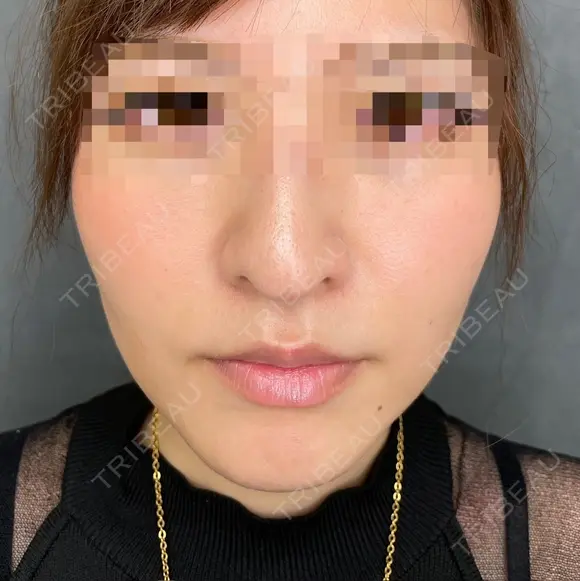 糸リフト after画像 メイン用