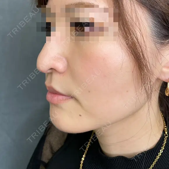 糸リフト after画像 メイン用