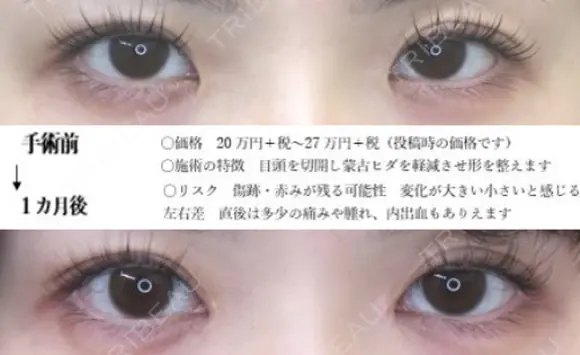 目頭切開 before画像 メイン用