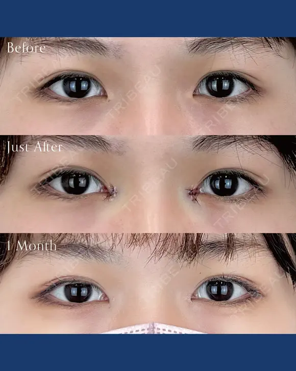 目頭切開 before画像 メイン用