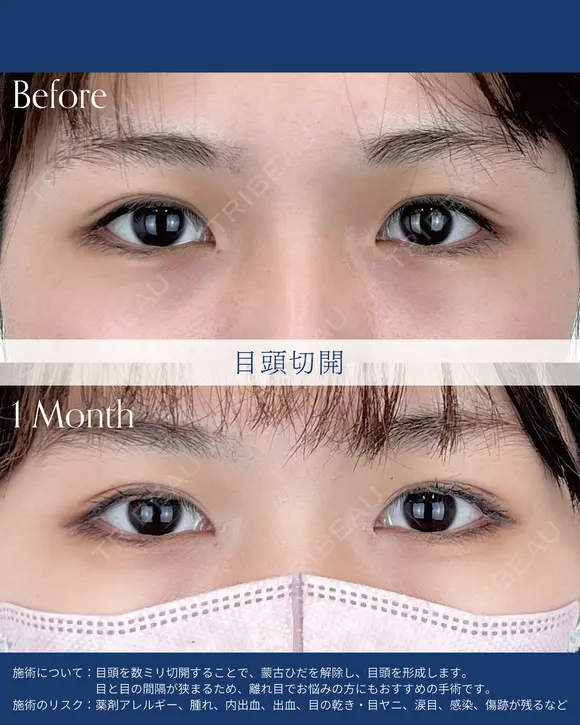 目頭切開 after画像 メイン用