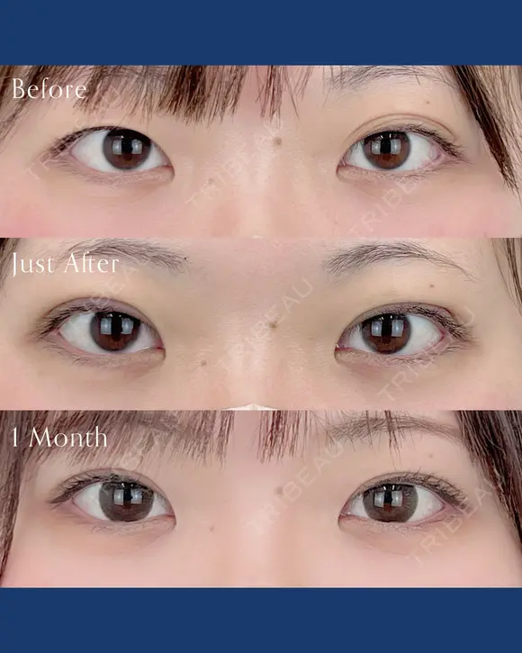 二重埋没法 before画像 メイン用