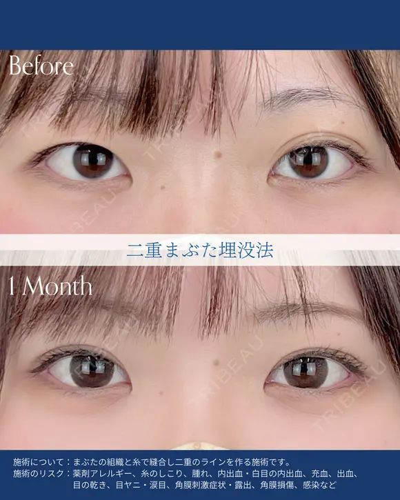 二重埋没法 after画像 メイン用