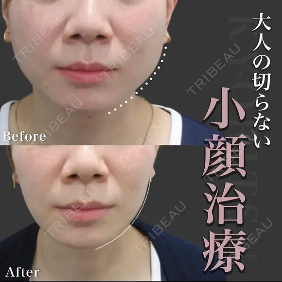 切らない小顔術｜エラボト＋スーパーHIFU pro before画像 メイン用