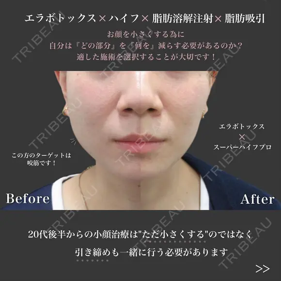 切らない小顔術｜エラボト＋スーパーHIFU pro after画像 メイン用