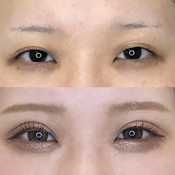 半永久的に理想の目元|二重切開全切開 before画像 メイン用