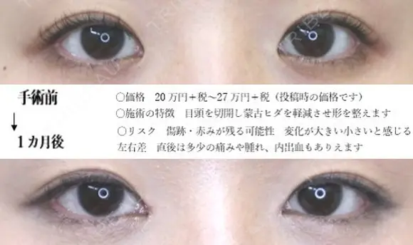 目頭切開 before画像 メイン用