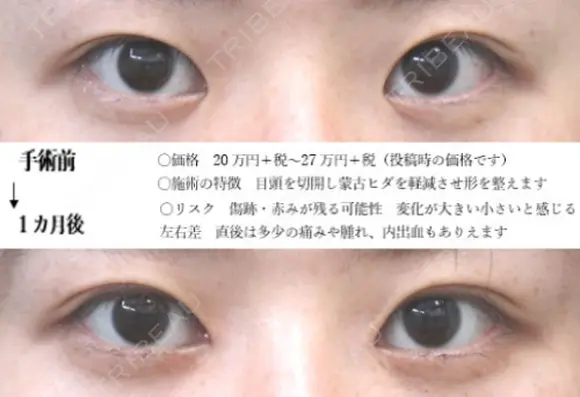目頭切開 before画像 メイン用