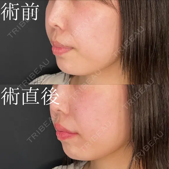 唇ヒアルロン酸 before画像 メイン用