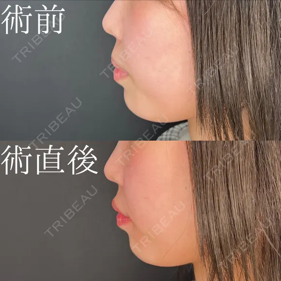 唇ヒアルロン酸 after画像 メイン用