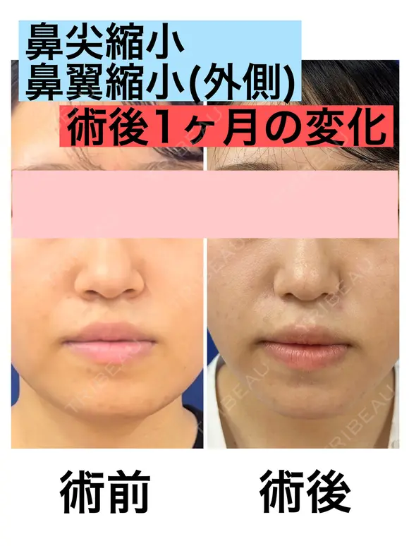 鼻尖縮小+鼻翼縮小(外側法) before画像 メイン用