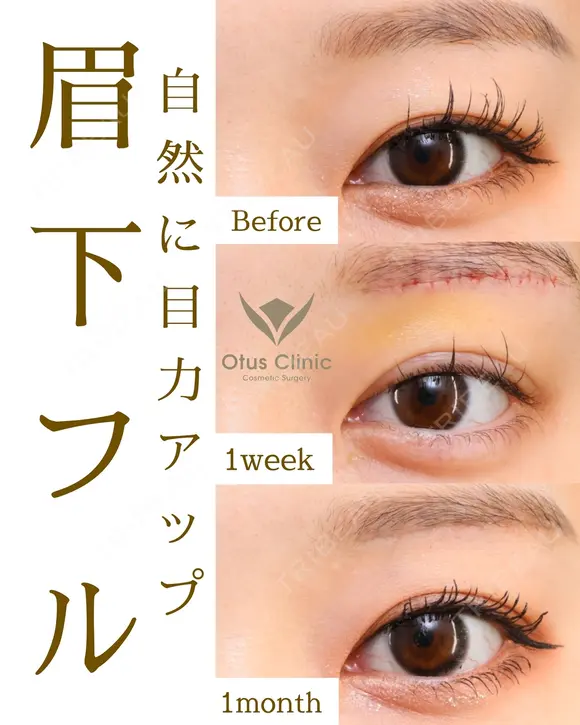 眉下切開・ROOF切除・眼窩脂肪移動 before画像 メイン用