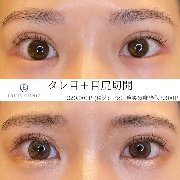 タレ目（埋没）+目尻切開 before画像 メイン用
