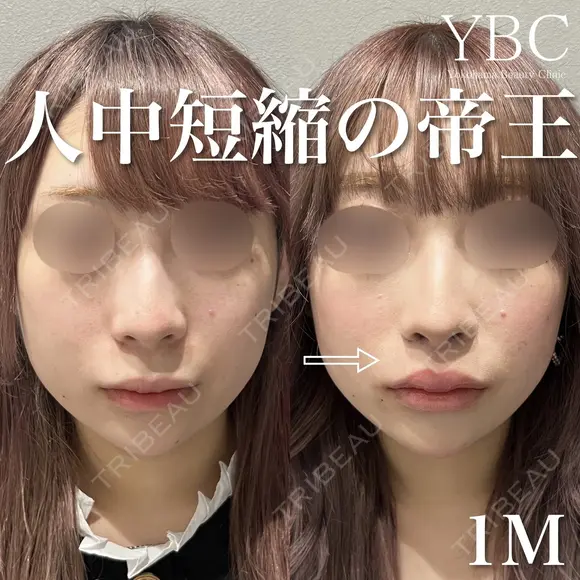 【人中短縮術】 after画像 メイン用