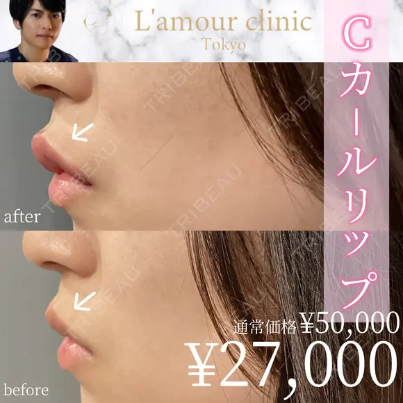 Cカールリップ before画像 メイン用