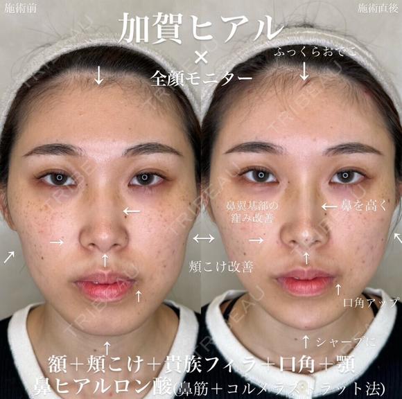Dr加賀デザイン＊鼻・頬・貴族フィラー・額・顎・唇ヒアルロン酸 before画像 メイン用