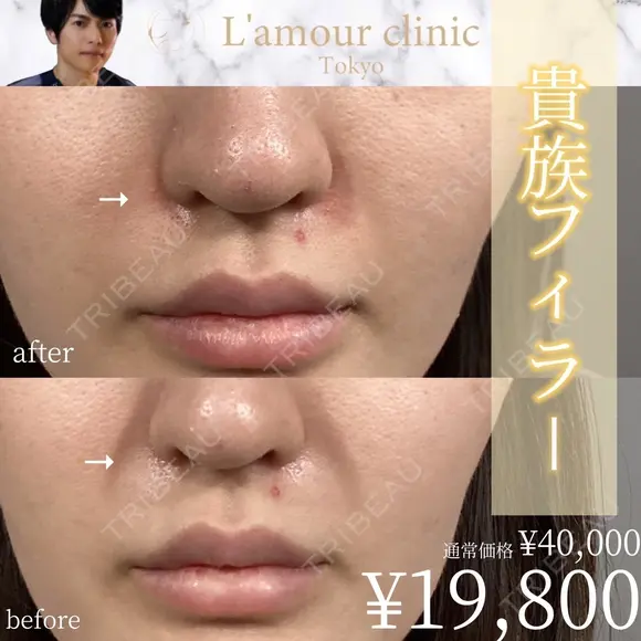 貴族フィラー 0日後 メイン用