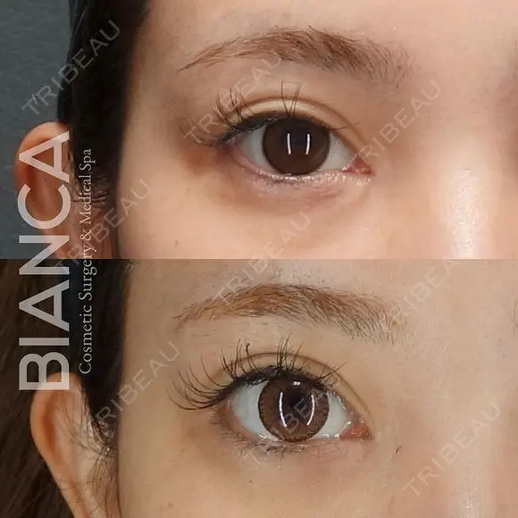 優しい印象の目元に💗グラマラスライン形成 before画像 メイン用
