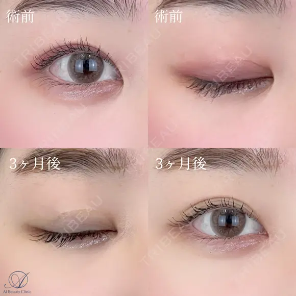 目頭切開 before画像 メイン用