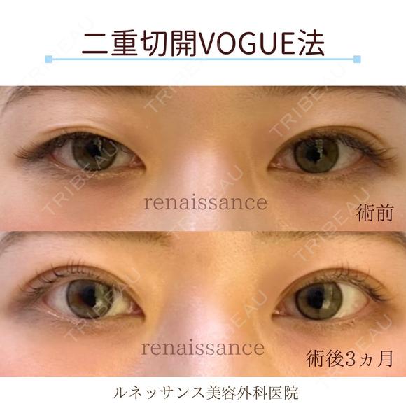 他院修正 二重切開VOGUE法💗 after画像 メイン用