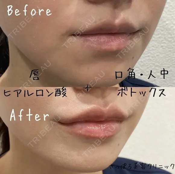 ぷっくりしたM字リップに💋｜唇ヒアル before画像 メイン用