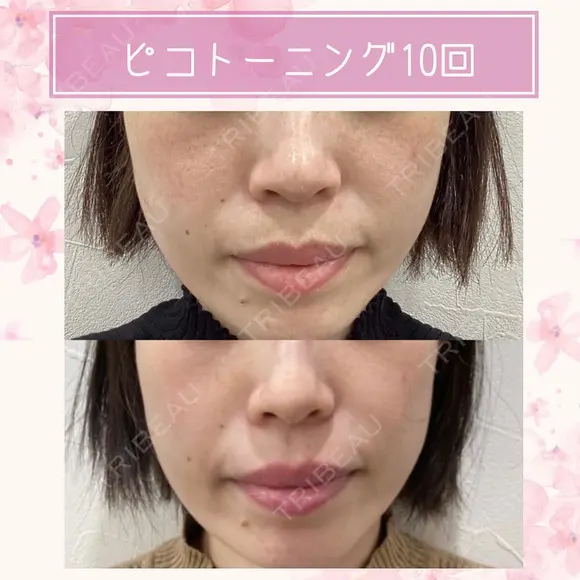ピコトーニング｜シミやくすみを改善してワントーンUP🤍 after画像 メイン用