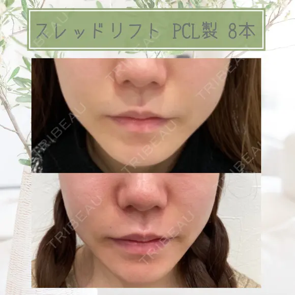  輪郭をスッキリと😌スレッドリフト after画像 メイン用