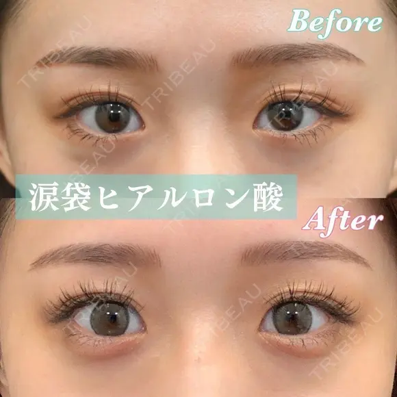 愛らしい目元に💗涙袋ヒアル before画像 メイン用