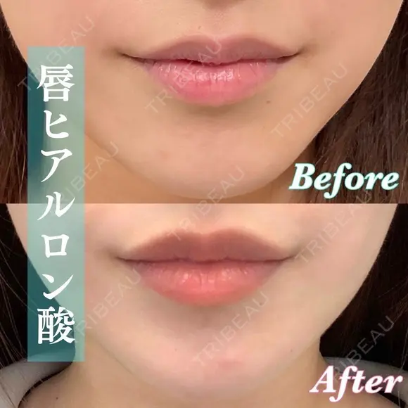 ぷっくりしたM字リップに💋｜唇ヒアル before画像 メイン用