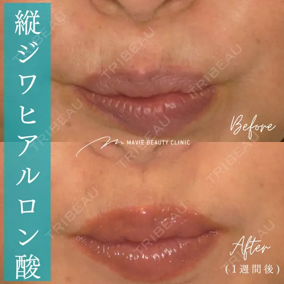 ヒアルロン酸注入（唇上の縦ジワ） before画像 メイン用