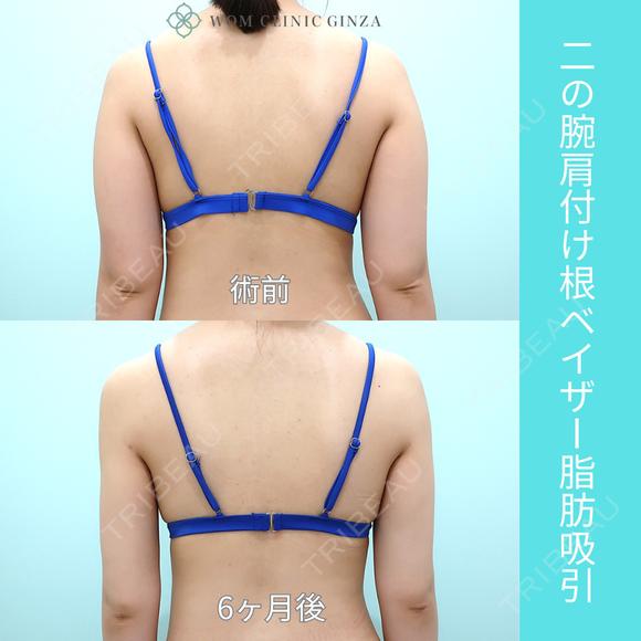 二の腕大量脂肪吸引でも、超滑らかで自然な仕上がり。吸引後の違和感全くなし！ 180日後 メイン用