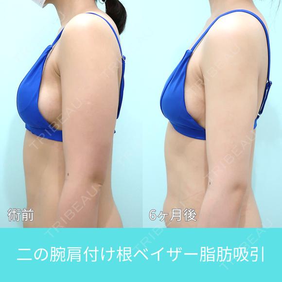 二の腕大量脂肪吸引でも、超滑らかで自然な仕上がり。吸引後の違和感全くなし！ 180日後 メイン用