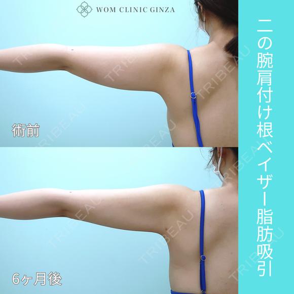 二の腕大量脂肪吸引でも、超滑らかで自然な仕上がり。吸引後の違和感全くなし！ 180日後 メイン用