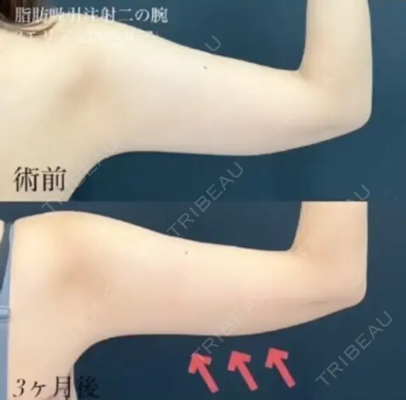 圧迫不要！脂肪吸引注射 💉でほっそり二の腕💗 before画像 メイン用