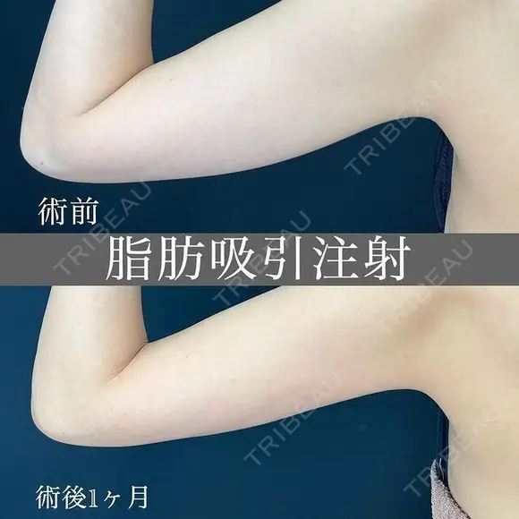 振り袖の部分痩せ❗脂肪吸引注射 💉 30日後 メイン用