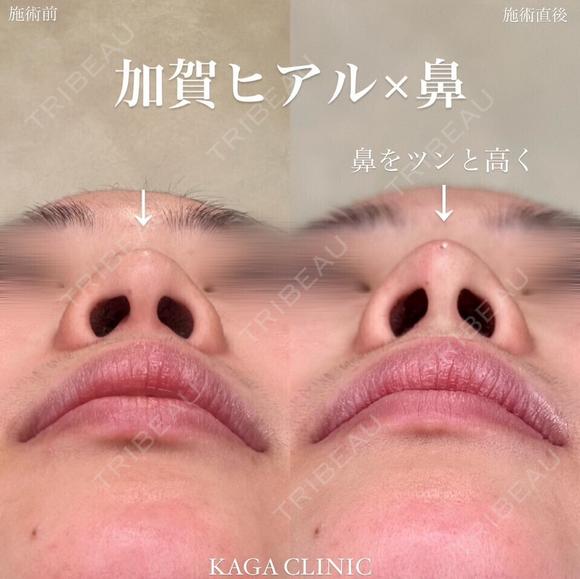 Dr加賀デザイン＊鼻ヒアルロン酸コルメラストラット法 before画像 メイン用