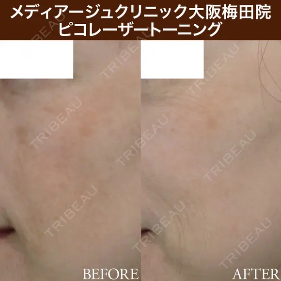 ピコレーザートーニング after画像 メイン用