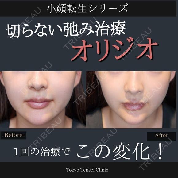 ”オリジオ”でリフトアップ小顔転生❤️‍🔥 after画像 メイン用
