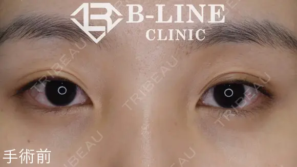 【韓流目頭切開術・切開法二重術】手術後3ヵ月 before画像 メイン用