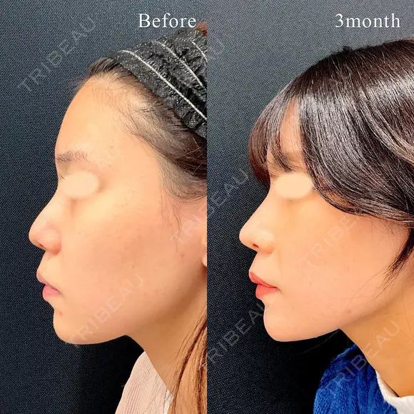 鼻尖形成3D法＋軟骨移植 before画像 メイン用