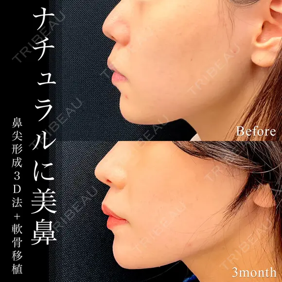 鼻尖形成3D法＋軟骨移植 90日後 メイン用