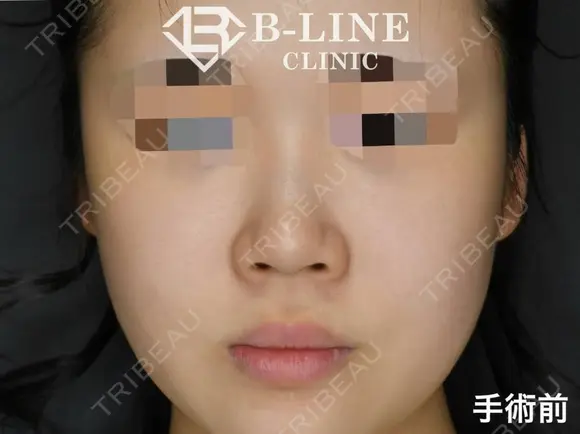【Gメッシュ】1週間後 before画像 メイン用