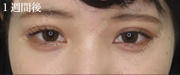 埋没法二重 after画像 メイン用