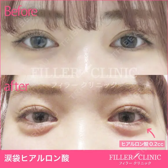 涙袋ヒアルロン酸 after画像 メイン用