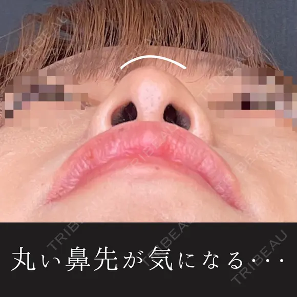 鼻ヒアルロン酸(コルメラストラット法) before画像 メイン用