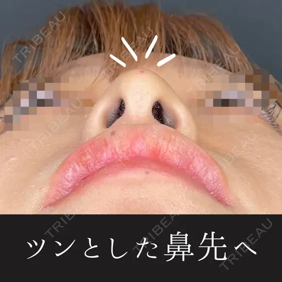 鼻ヒアルロン酸(コルメラストラット法) after画像 メイン用