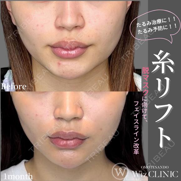 たるみ治療・予防に🪡糸リフト（VOVリフト4本＋テスリフト4本） before画像 メイン用