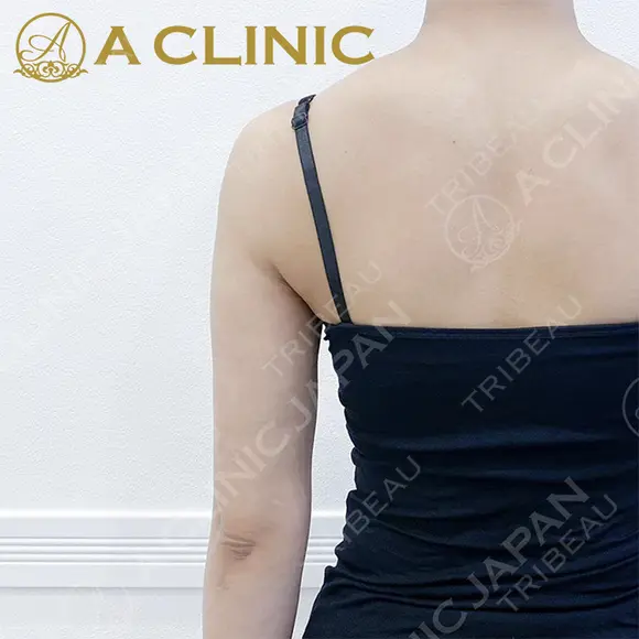 【二の腕スリム脂肪吸引】二の腕スリム脂肪吸引で腕が綺麗なストレートに変化！処置前と2ヶ月後の症例です after画像 メイン用