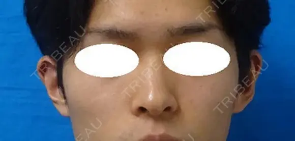 立ち耳修正・耳介形成 after画像 メイン用