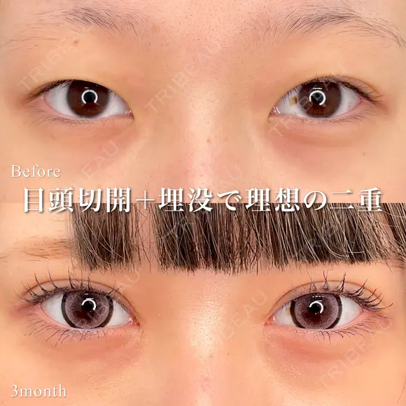 二重埋没法＋目頭切開 90日後 メイン用